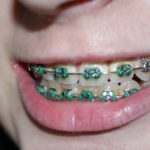 how to remove plaque buildup on braces